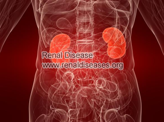 A Patient Story with Stage 5 CKD And Diabetic Nephropathy