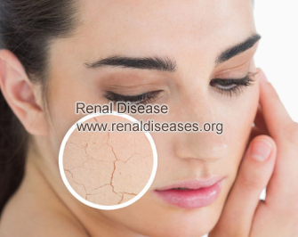 What Treatments Are Used to Solve Dry Skin in IgA Nephropathy