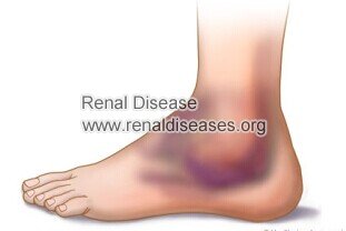 Swelling in Children Nephrotic Syndrome