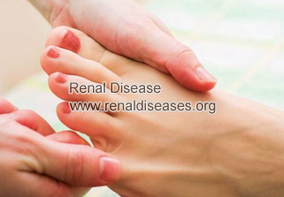 Numbness in Toes And Diabetic Nephropathy: Causes and Treatment