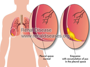 Causes of Nephrotic Syndrome With Pleural Effusions
