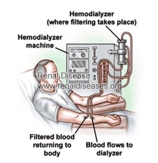 Can A Person Stop Dialysis Once He Begins