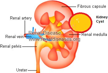 How to Remove 8.9 cm Cysts on Kidney