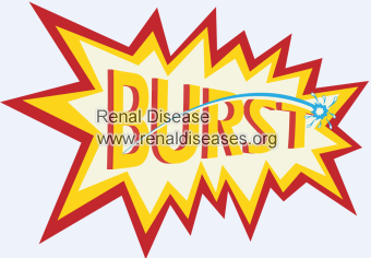 Can A Cyst Burst on Your Kidneys