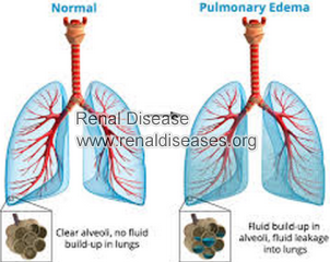 Can Chronic Kidney Disease Cause Pulmonary Edema  