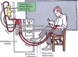 How Long Can Stage 5 CKD with Dialysis