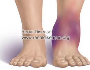 Foods to Be Eaten for Treating Swelling in Stage 3 CKD