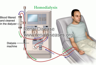 How Hemodialysis Helps A Person with PKD