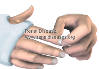 Can Kidney Disease Cause Blue Fingernails and Toenails