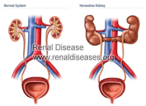 How Horseshoe Kidney Affects Renal Function