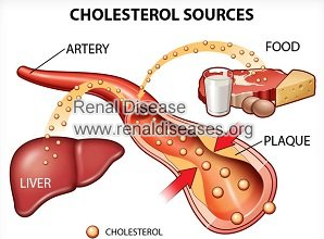 What Causes Hyperlipidemia in Nephropatic Syndrome