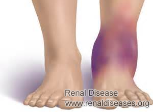 Chinese Therapy for Relieving Swelling for Nephrotic Syndrome Patients