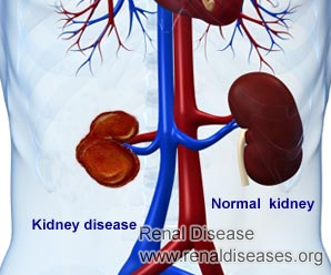 Can Chronic Kidney Disease Be Reversible