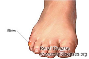 How to Treat Blisters for Kidney Failure Patients
