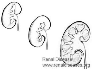 How to Treat Shrinking Kidneys Degenerative Disease
