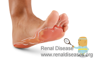 How to Treat Blisters on Foot for Kidney Failure Patients