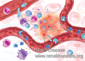 Immune System Symptoms in FSGS