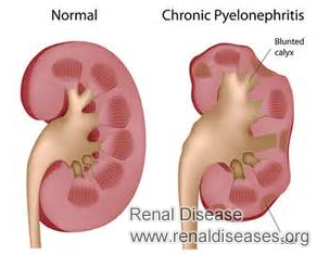 ADPKD with Creatinine 2.9: Causes, Symptoms and Treatments
