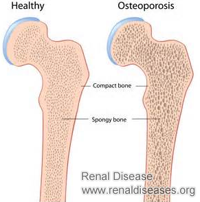 How to Deal with Osteoporosis for Dialysis Patients