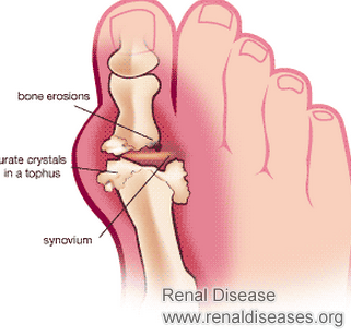 Is There Any Connection Between Gout and Kidney Disease
