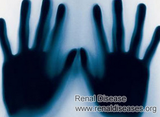 How Does Black Color in Palm Occur in Kidney Disease