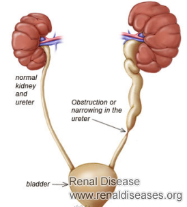 Top Three Steps to Treat Hydronephrosis