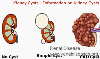 Is There An Alternative Method to Delete the Cyst