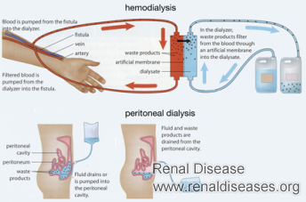Hemodialysis and Pertioneal Dialysis: Which One is Safe for Kidney Failure Patients