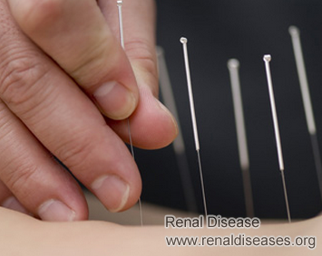 Does Acupuncture Work for ESRD