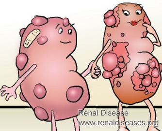 What Will Happen in Stage 4 PKD