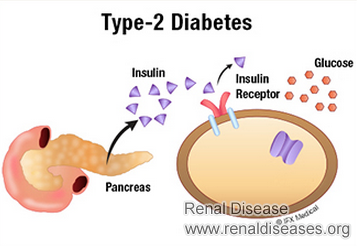 How to Treat Diabetes Type 2 Naturally