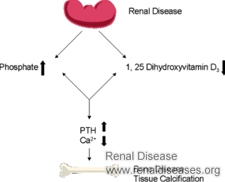Hyperphosphatemia Symptoms in Chronic Kidney Disease