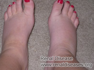 Can Foot Swelling Be Due to Kidney Disease