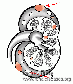 Natural Remedy for Kidney Cyst Measuring 6.2 * 5 cm