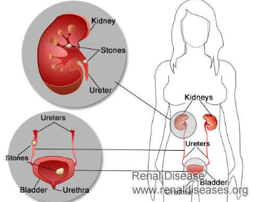 Potential Complications of Chronic Kidney Disease Stage 3