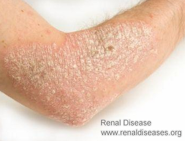 Can Kidney Disease Cause Dry Flaky Skin