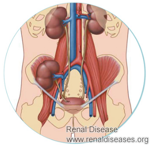 Why IgA Nephropathy Reoccurs After A Kidney Transplant