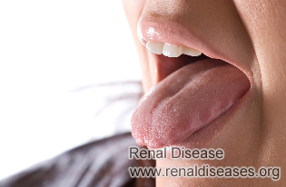 Lupus with Swollen Tongue: Causes and Treatment