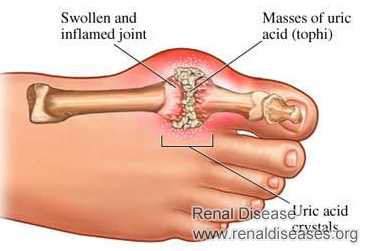 Is There Any Medications for Gout and Kidney Disease
