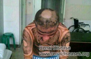 New Treatment in 2014 for Diabetic Nephropathy