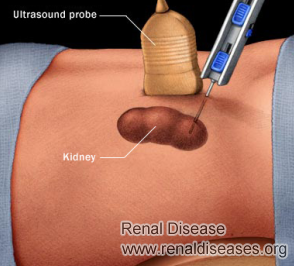 How to Diagnose Kidney Disease without Renal Puncture