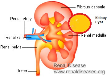 Can Complex Kidney Cyst Go Away on Its Own