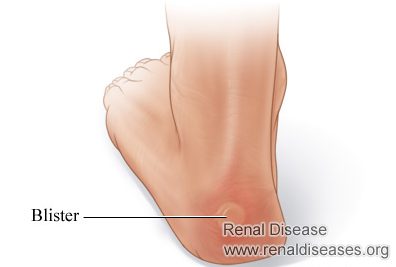 Why Someone Who Is on Dialysis Would Be Getting Blisters