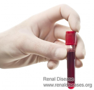 What May Cause High Creatinine Levels in Blood