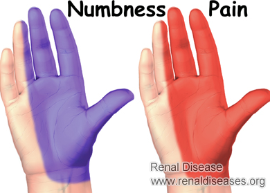 Is It Dangerous to Experince Numbness in Hands after Dialysis