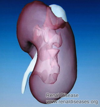 What Does It Mean When a Low Density Tiny Cyst on Kidney