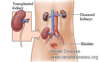 Is Kidney Transplant the End Solution for Kidney Failure Patients