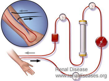Are There Any Chances for Kidney Failure Patients to Get Well Only by Dialysis