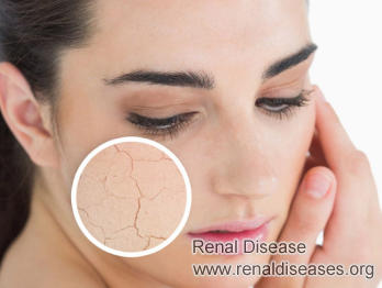 Dry Skin Conditions Caused by Kidney Disease