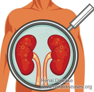 Kidney Cyst 2.7x2.1cm on Right Kidney: Causes and Risks